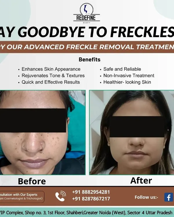 A fantastic before-and-after result for freckle removal. This treatment helps to even out skin tone and texture, giving the face a clearer and more rejuvenated appearance.