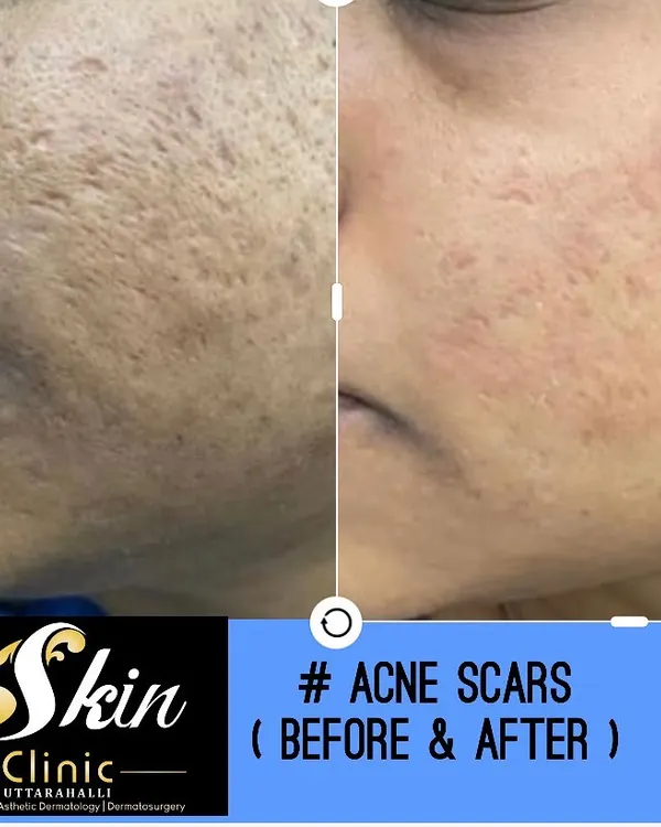 A clear before and after comparison of our advanced acne scar revision treatment. This shows a significant reduction in the depth and texture of pitted scars, resulting in smoother, clearer skin on the patient's cheek.
