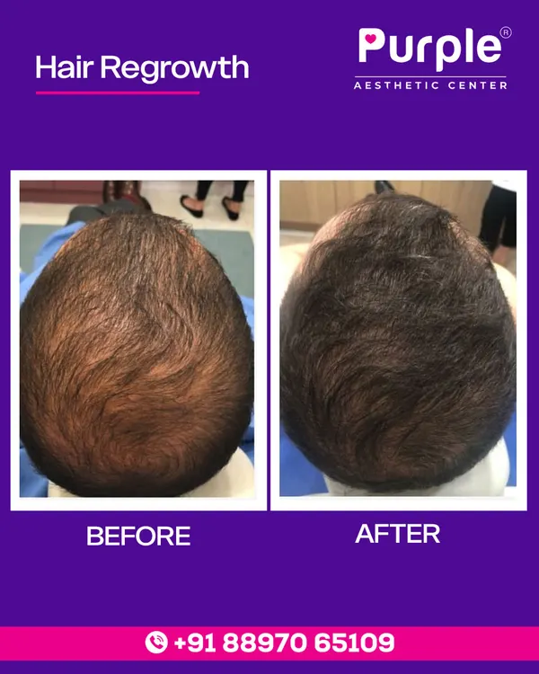 The results speak for themselves. This before and after photo shows the significant improvement in hair density and coverage after our customized hair regrowth treatment plan.