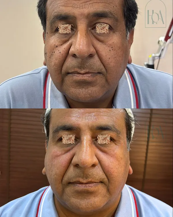 Are skin tags, moles, or warts affecting your skin's texture and tone? We offer advanced, minimally invasive treatments to safely remove these common growths, leaving your skin smoother, clearer, and more radiant.