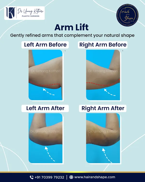 Sagging skin on the upper arms, often called "bat wings," is a common concern. An arm lift, or brachioplasty, is a procedure I perform to remove this loose skin and fat. The result is a smoother, more toned arm contour that complements your natural body shape, as you can see in this before and after.