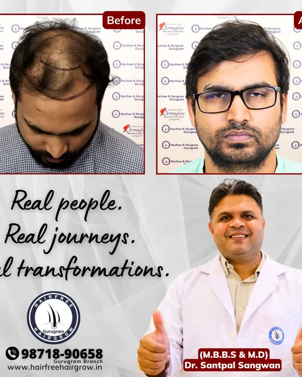 This is the result of a personalized hair restoration journey. We addressed Grade 5 baldness with an advanced 5200-graft FUE procedure, and in 12 months, you can see the complete transformation. My goal is to create a natural hairline and restore density, which in turn restores confidence.