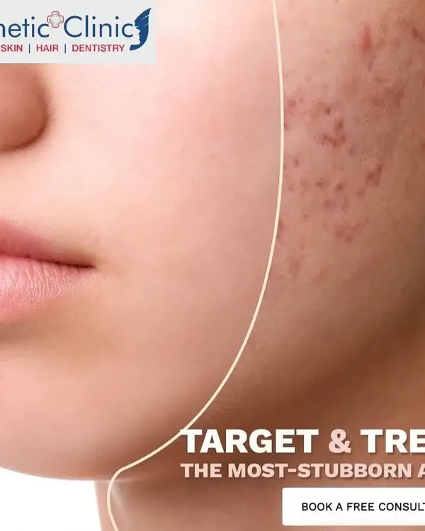 Stubborn acne requires a targeted clinical approach. I offer customized laser treatments designed to address persistent breakouts and help you achieve clearer skin.