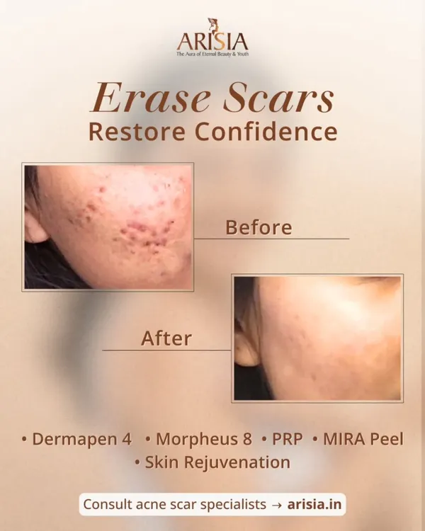 This is what we aim for: restoring not just your skin, but your confidence. Using a combination of advanced, US-FDA approved treatments like Dermapen 4 and Morpheus 8, I create a personalized plan to significantly reduce the appearance of acne scars, including deep-set boxcar and rolling scars.