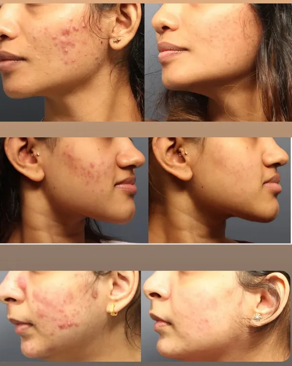 From Persistent Acne to Clear Confidence. These before-and-after images show the significant reduction in inflammatory acne and post-acne marks. A consistent, tailored regimen makes all the difference.