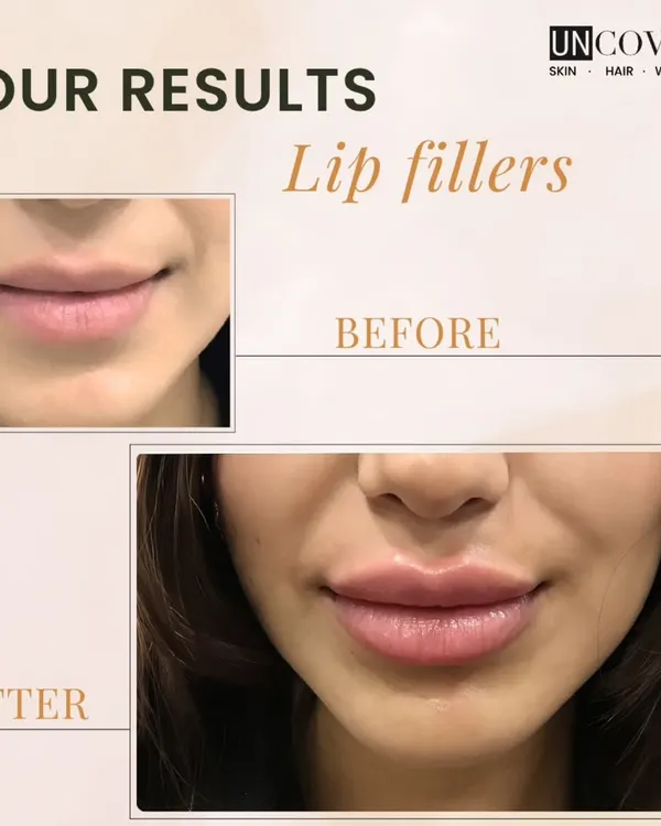 This before and after showcases our philosophy on lip fillers. We focus on enhancing your natural beauty by adding subtle volume and definition for a result that is balanced and beautiful.